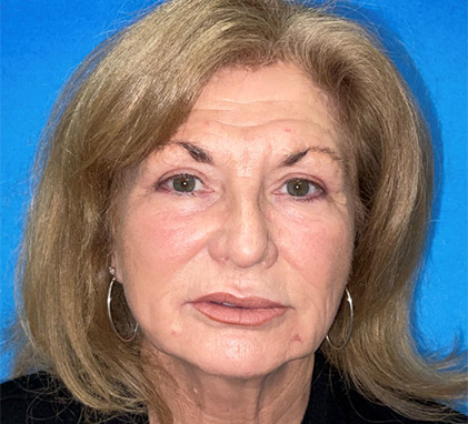 Botox and Filler Facial Recontouring Before Image