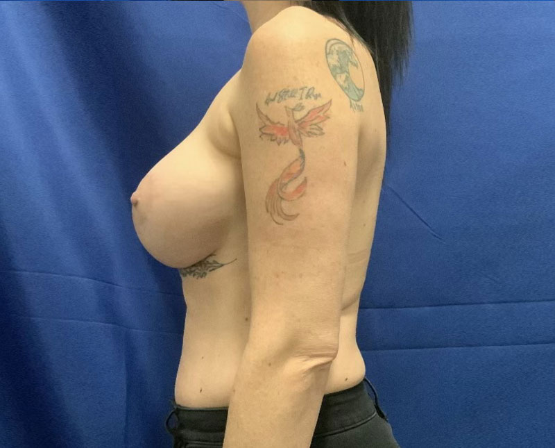 39 year-old mother is shown here 5 months after bilateral breast augmentation with peri areolar mastopexy with 455 cc shaped high profile implants