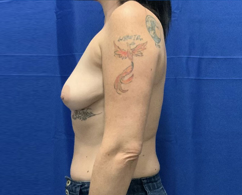 39 year-old mother is shown here 5 months after bilateral breast augmentation with peri areolar mastopexy with 455 cc shaped high profile implants