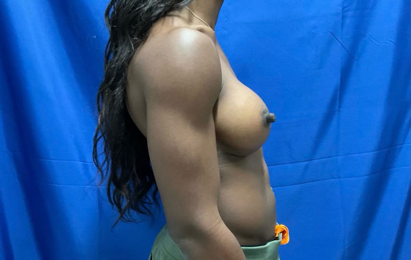 Shown is a woman in her mid twenties 4 months after bilateral breast augmentation with Sientra Gel Xtra High Profile smooth round implants Shown is a woman in her mid twenties 4 months after bilateral breast augmentation with Sientra Gel Xtra High Profile smooth round implants