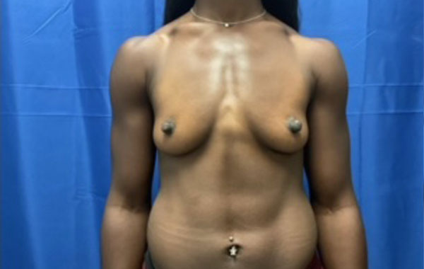 Shown is a woman in her mid twenties 4 months after bilateral breast augmentation with Sientra Gel Xtra High Profile smooth round implants