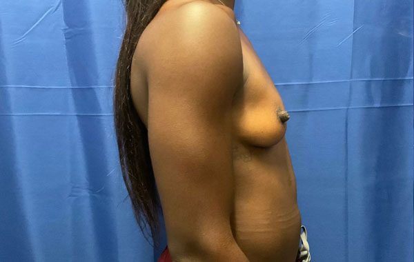 Shown is a woman in her mid twenties 4 months after bilateral breast augmentation with Sientra Gel Xtra High Profile smooth round implants Shown is a woman in her mid twenties 4 months after bilateral breast augmentation with Sientra Gel Xtra High Profile smooth round implants
