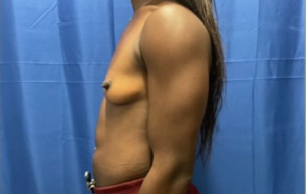 Shown is a woman in her mid twenties 4 months after bilateral breast augmentation with Sientra Gel Xtra High Profile smooth round implants Shown is a woman in her mid twenties 4 months after bilateral breast augmentation with Sientra Gel Xtra High Profile smooth round implants