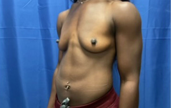 Shown is a woman in her mid twenties 4 months after bilateral breast augmentation with Sientra Gel Xtra High Profile smooth round implants Shown is a woman in her mid twenties 4 months after bilateral breast augmentation with Sientra Gel Xtra High Profile smooth round implants