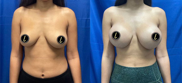 breast augmentation
