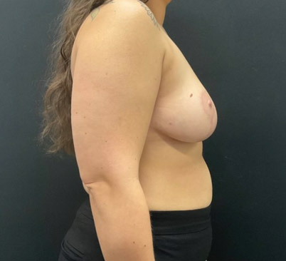 34 year old 3 months after bilateral breast reduction. Over 2 pounds removed from each breast