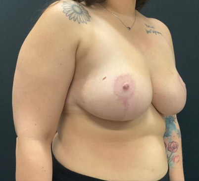 34 year old 3 months after bilateral breast reduction. Over 2 pounds removed from each breast