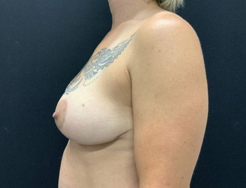 A woman in her 40s is shown 3 months after bilateral breast reduction A woman in her 40s is shown 3 months after bilateral breast reduction