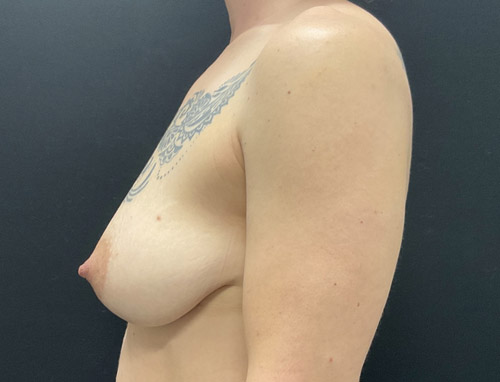 A woman in her 40s is shown 3 months after bilateral breast reduction A woman in her 40s is shown 3 months after bilateral breast reduction