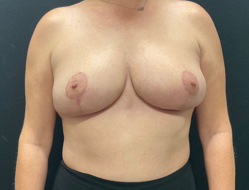 38 year old female only 2 months after bilateral breast reduction