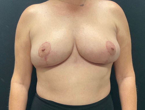 38 year old female only 2 months after bilateral breast reduction 38 year old female only 2 months after bilateral breast reduction