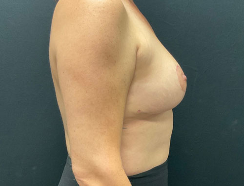 38 year old female only 2 months after bilateral breast reduction