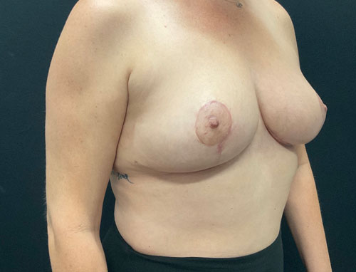 38 year old female only 2 months after bilateral breast reduction