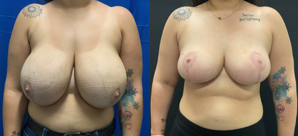 breast-reduction