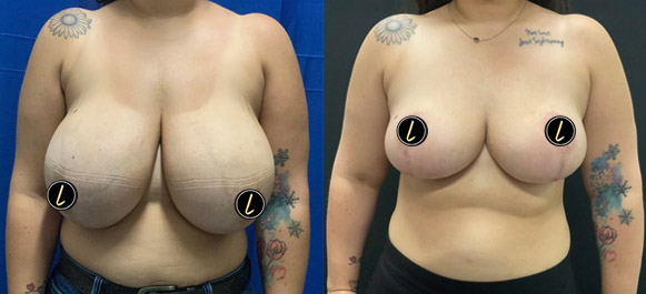 breast reduction