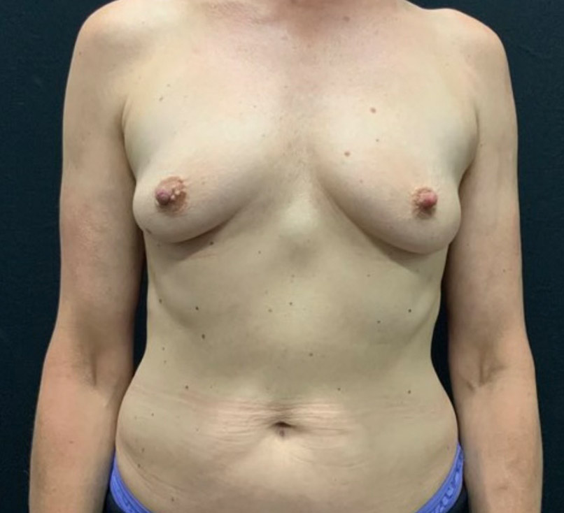 47 year old female shown 3 months after bilateral breast augmentation with 305 cc Sientra Moderate Profile gel implants
