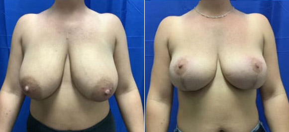 breast-lift