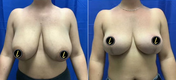breat lift