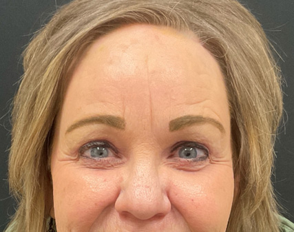 Endoscopic Brow Lift, Upper Blepharoplasty & Lower Blepharoplasty