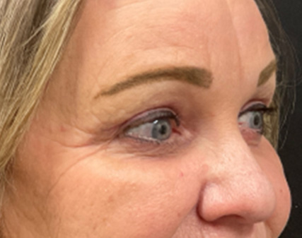 Endoscopic Brow Lift, Upper Blepharoplasty & Lower Blepharoplasty