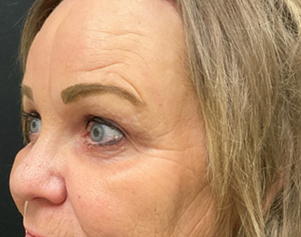 Endoscopic Brow Lift, Upper Blepharoplasty & Lower Blepharoplasty