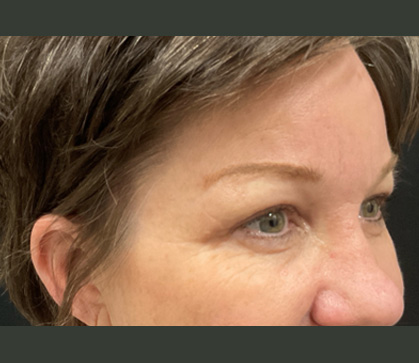 Endoscopic Brow and Upper Blepharoplasty