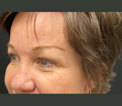 Endoscopic Brow and Upper Blepharoplasty