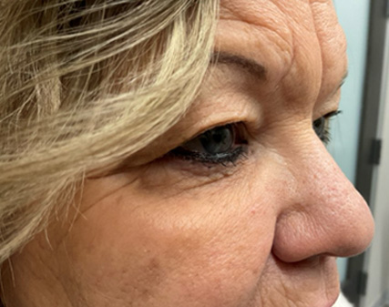 Endoscopic Brow Lift, Upper Blepharoplasty & Lower Blepharoplasty