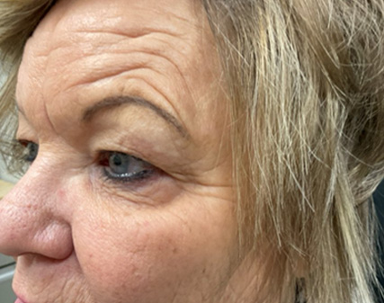 Endoscopic Brow Lift, Upper Blepharoplasty & Lower Blepharoplasty