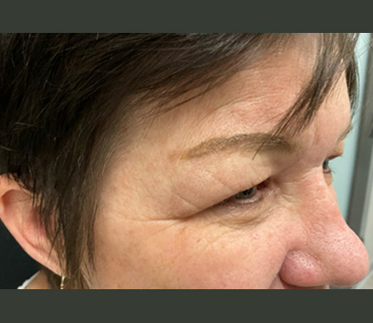 Endoscopic Brow and Upper Blepharoplasty