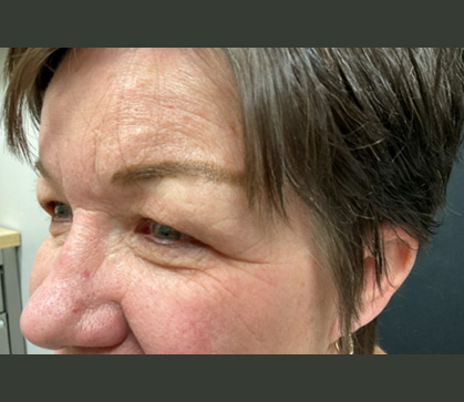 Endoscopic Brow and Upper Blepharoplasty