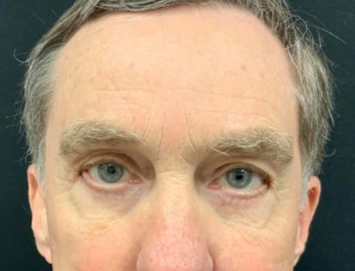Before and After Endoscopic brow lift, upper blepharoplasty, and bone fixation canthopexy
