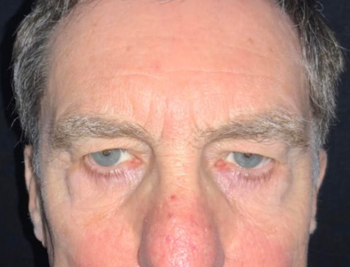Before and After Endoscopic brow lift, upper blepharoplasty, and bone fixation canthopexy