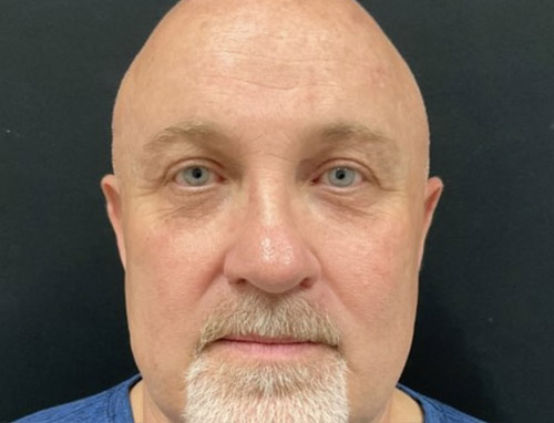 Shown is a man in his early 50s 3 months after an endoscopic brow lift, bilateral upper blepharoplasties and a functional rhinoplasty.