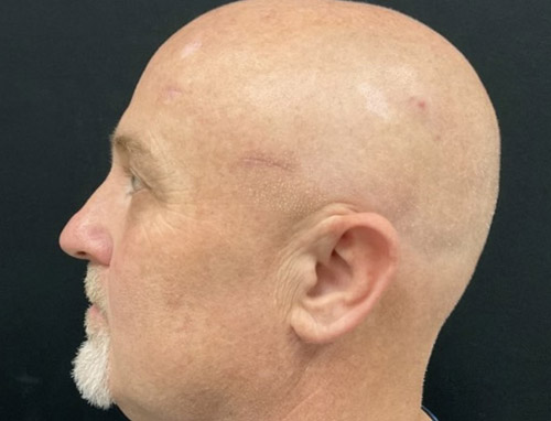 Shown is a man in his early 50s 3 months after an endoscopic brow lift, bilateral upper blepharoplasties and a functional rhinoplasty.