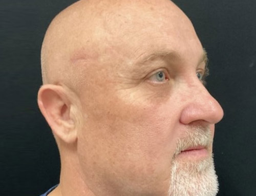 Shown is a man in his early 50s 3 months after an endoscopic brow lift, bilateral upper blepharoplasties and a functional rhinoplasty.