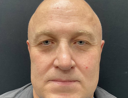 Shown is a man in his early 50s 3 months after an endoscopic brow lift, bilateral upper blepharoplasties and a functional rhinoplasty.