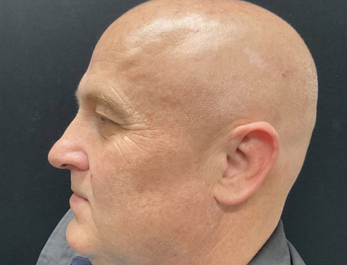 Shown is a man in his early 50s 3 months after an endoscopic brow lift, bilateral upper blepharoplasties and a functional rhinoplasty.