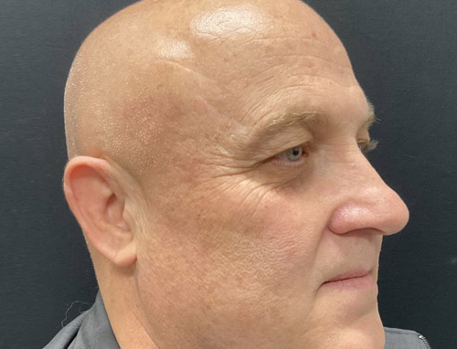 Shown is a man in his early 50s 3 months after an endoscopic brow lift, bilateral upper blepharoplasties and a functional rhinoplasty.