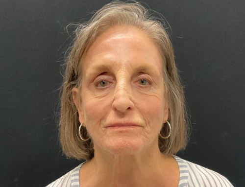 76 year old female 1 month after 30 percent TCA peel, Botulinum Toxin injections to her forehead, glabellar, and peri orbital area and lip filler