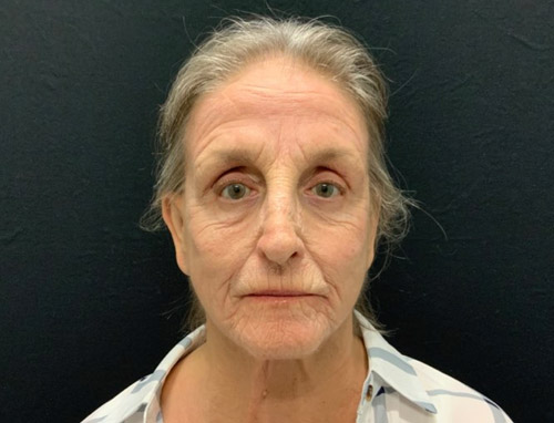 76 year old female 1 month after 30 percent TCA peel, Botulinum Toxin injections to her forehead, glabellar, and peri orbital area and lip filler