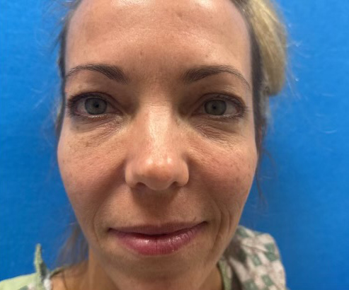 45 year old woman shown only 1 month after Obagi 26% TCA controlled depth peel.