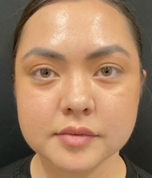 28 year old female shown 3 months after buccal fat removal and a chin implant