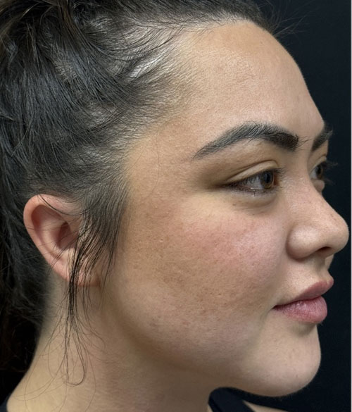 28 year old female shown 3 months after buccal fat removal and a chin implant