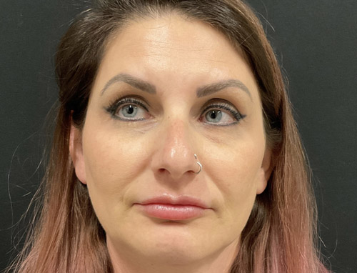 A woman in her early 40s shown 3.5 months after a chin implant, deep plane neck lift and jaw line liposuction