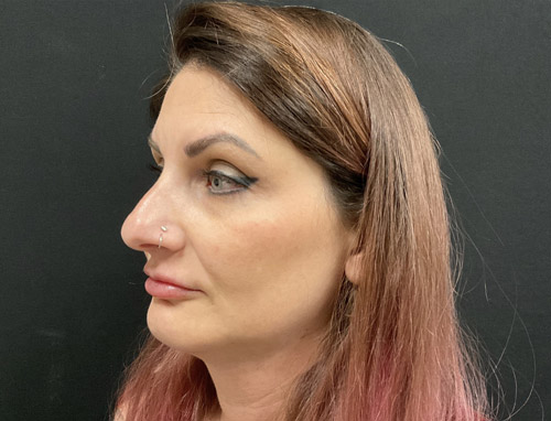 A woman in her early 40s shown 3.5 months after a chin implant, deep plane neck lift and jaw line liposuction