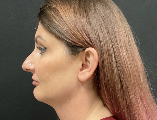 A woman in her early 40s shown 3.5 months after a chin implant, deep plane neck lift and jaw line liposuction