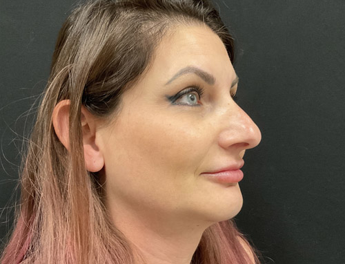 A woman in her early 40s shown 3.5 months after a chin implant, deep plane neck lift and jaw line liposuction