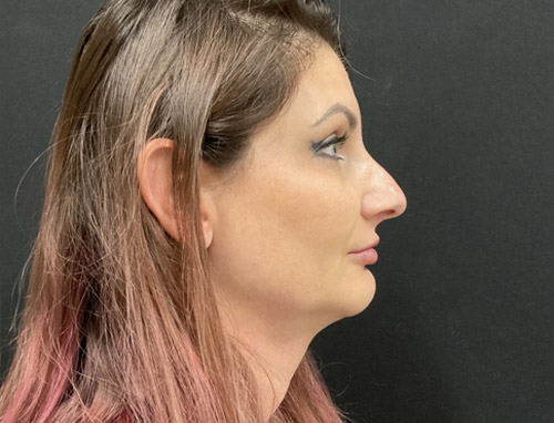 A woman in her early 40s shown 3.5 months after a chin implant, deep plane neck lift and jaw line liposuction