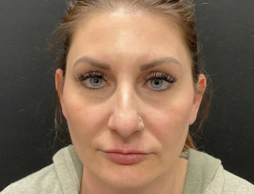 A woman in her early 40s shown 3.5 months after a chin implant, deep plane neck lift and jaw line liposuction